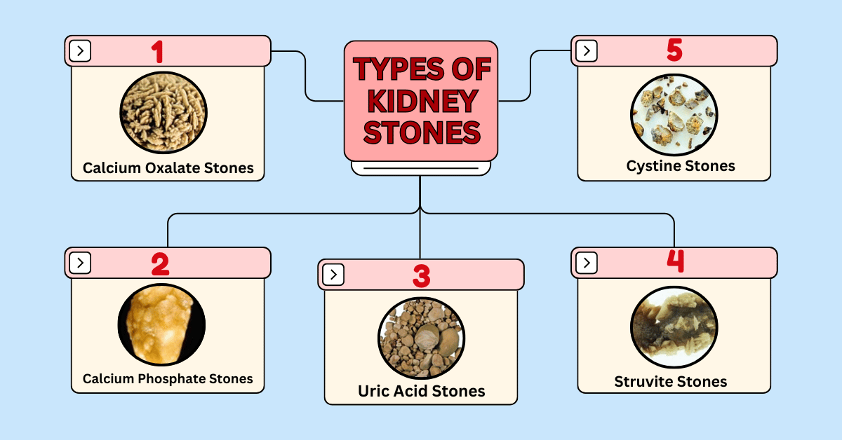 Diagram showing different types of kidney stones